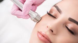 Microdermabrasion Treatment